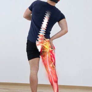 Sciatica1