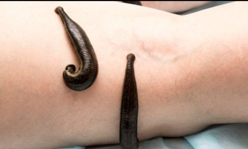 Leech Therapy3